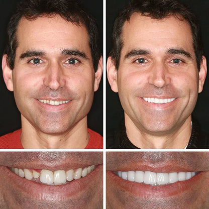 Ends Today: 70% OFF! ⏰DarkFairy™ Medical Full Denture with Strong Suctiond🦷Obtain American Dental Association (ADA) Certification
