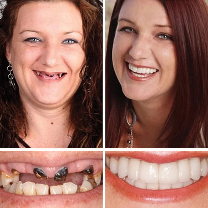 🌎Ends Today: 70% OFF! ⏰ Medical Full Denture with Strong Suctiond