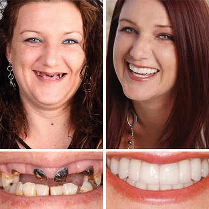 🌎Ends Today: 70% OFF! ⏰ Medical Full Denture with Strong Suctiond