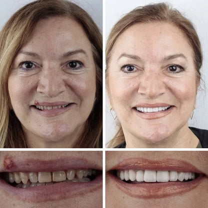 Ends Today: 70% OFF! ⏰DarkFairy™ Medical Full Denture with Strong Suctiond🦷Obtain American Dental Association (ADA) Certification