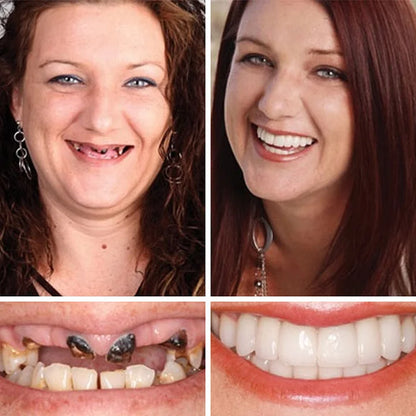 Ends Today: 70% OFF! ⏰DarkFairy™ Medical Full Denture with Strong Suctiond🦷Obtain American Dental Association (ADA) Certification